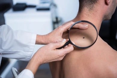 A dermatologist examining a mole on a man's back